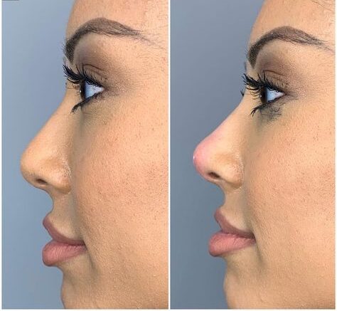 Nose Threads Before and After: Understanding the Transformation