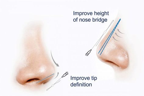 Nose Threads Before and After: Understanding the Transformation