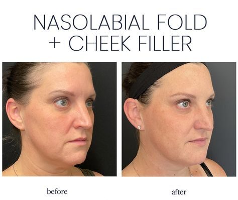 Overfilled Nasolabial Folds: Solutions, and Long-term Effects