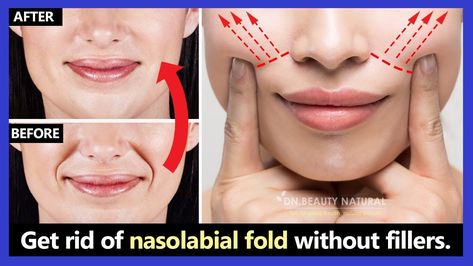 Overfilled Nasolabial Folds: Solutions, and Long-term Effects