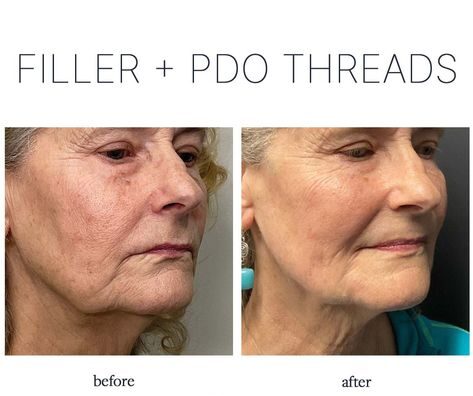 PDO Lift Before and After: Transformational Results You Need 