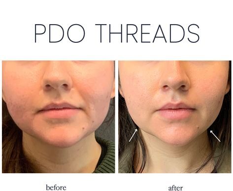 PDO Lift Before and After: Transformational Results You Need 