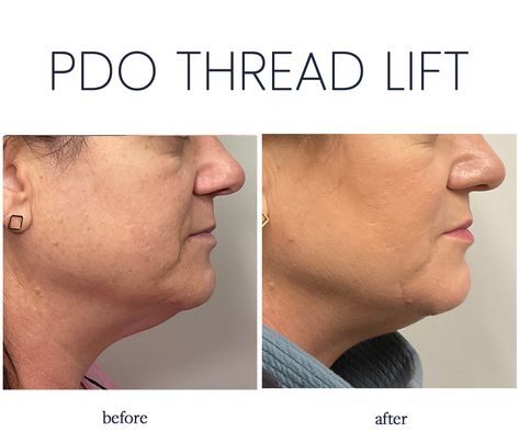 PDO Lift Before and After: Transformational Results You Need 