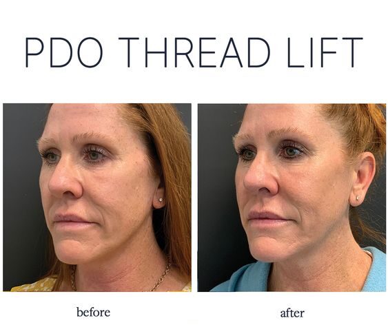 PDO Thread Lift NYC: The Ultimate Non-Surgical Facelift Solution