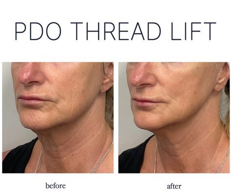 PDO Thread Lift NYC: The Ultimate Non-Surgical Facelift Solution