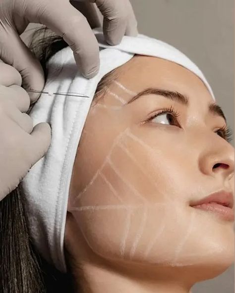 PDO Thread Lift NYC: The Ultimate Non-Surgical Facelift Solution