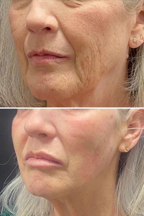 PDO Thread Lift NYC: The Ultimate Non-Surgical Facelift Solution