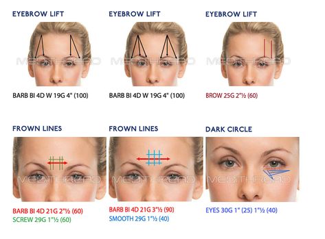 PDO Thread Lift NYC: The Ultimate Non-Surgical Facelift Solution