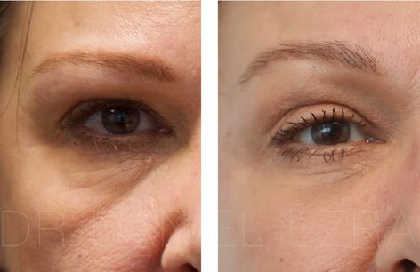 PDO Thread Under Eye: Solution for Youthful Eyes