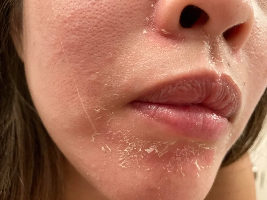 Peeling Skin Around Lips