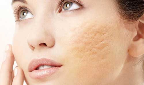 People with deep acne scars