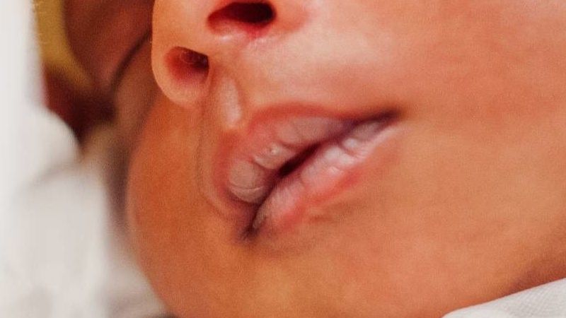 persistent lip peeling in newborns