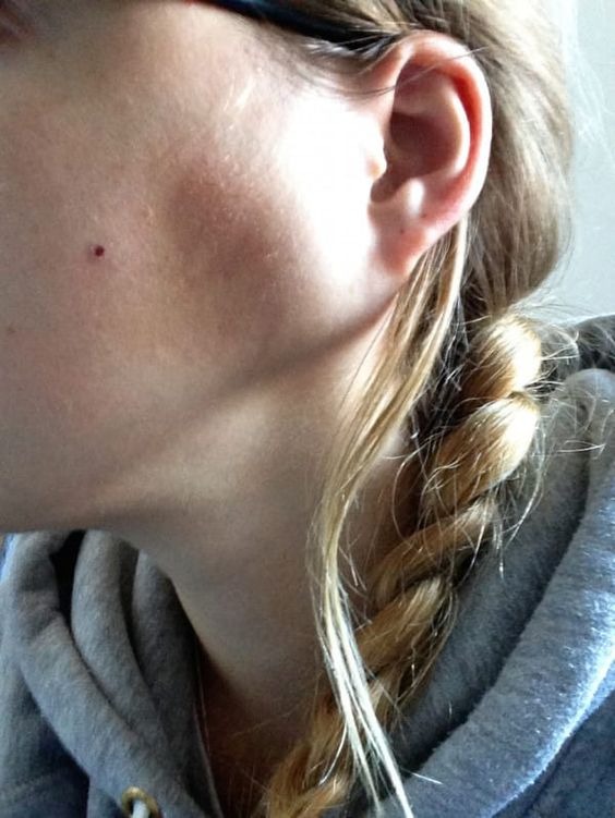 Persistent Swelling or Bruising jaw