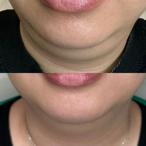 Products for Double Chin