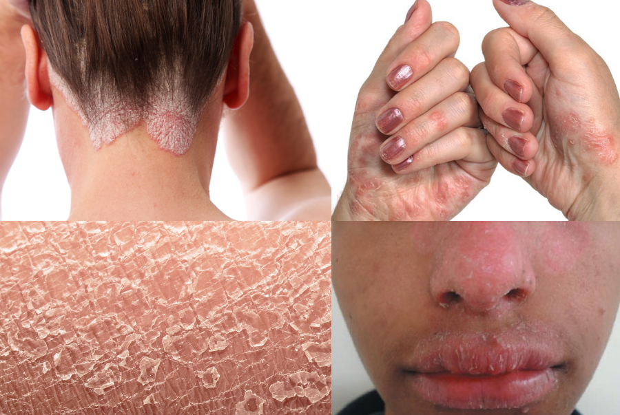 Psoriasis 