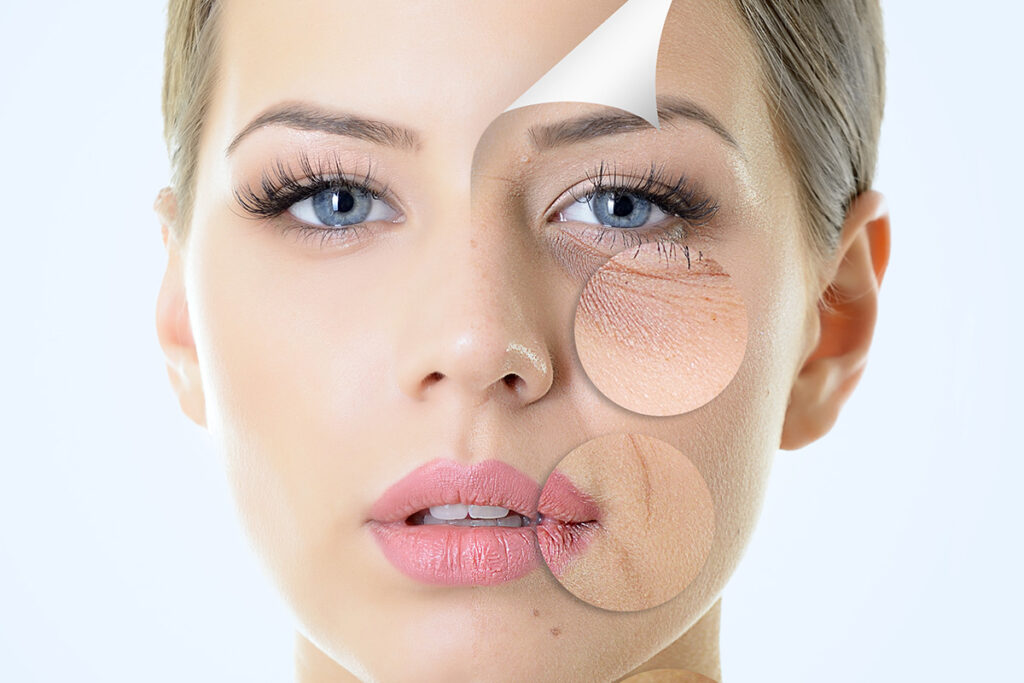 Reduction of Fine Lines and Wrinkles