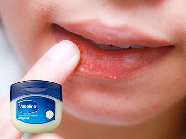 Role of Vaseline in Lip Care