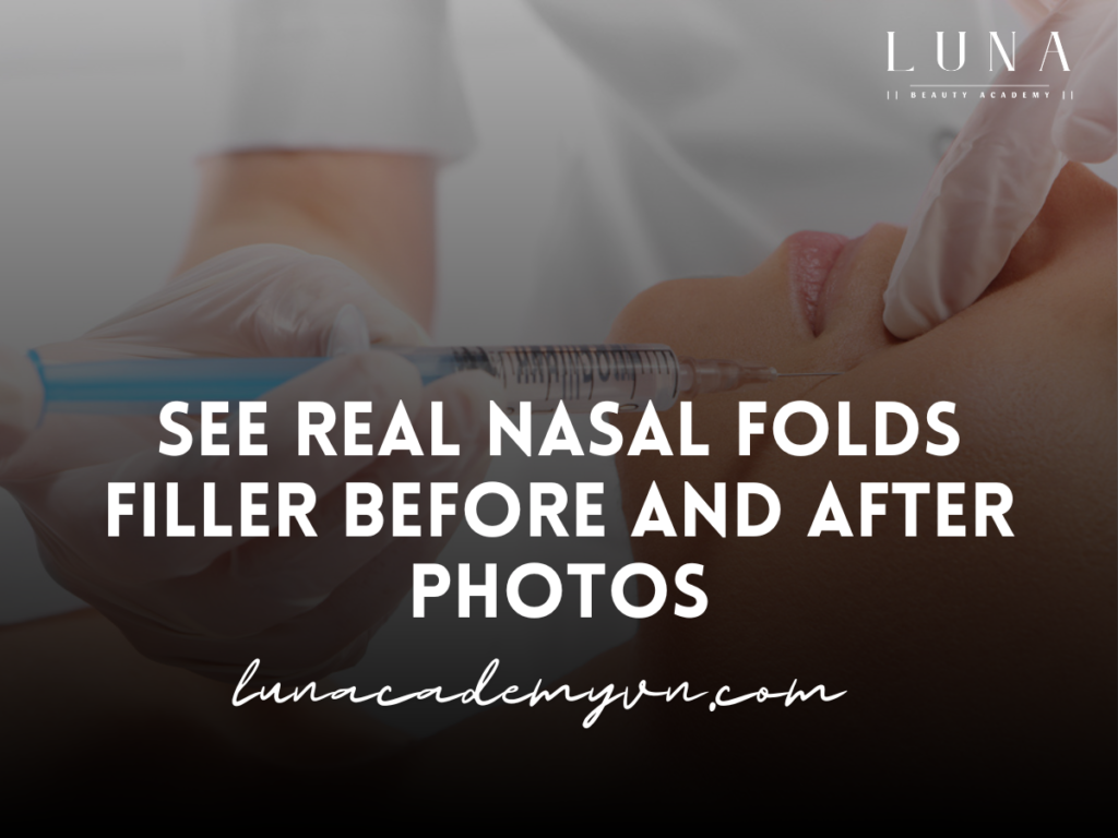 See Real Nasal Folds Filler Before and After Photos