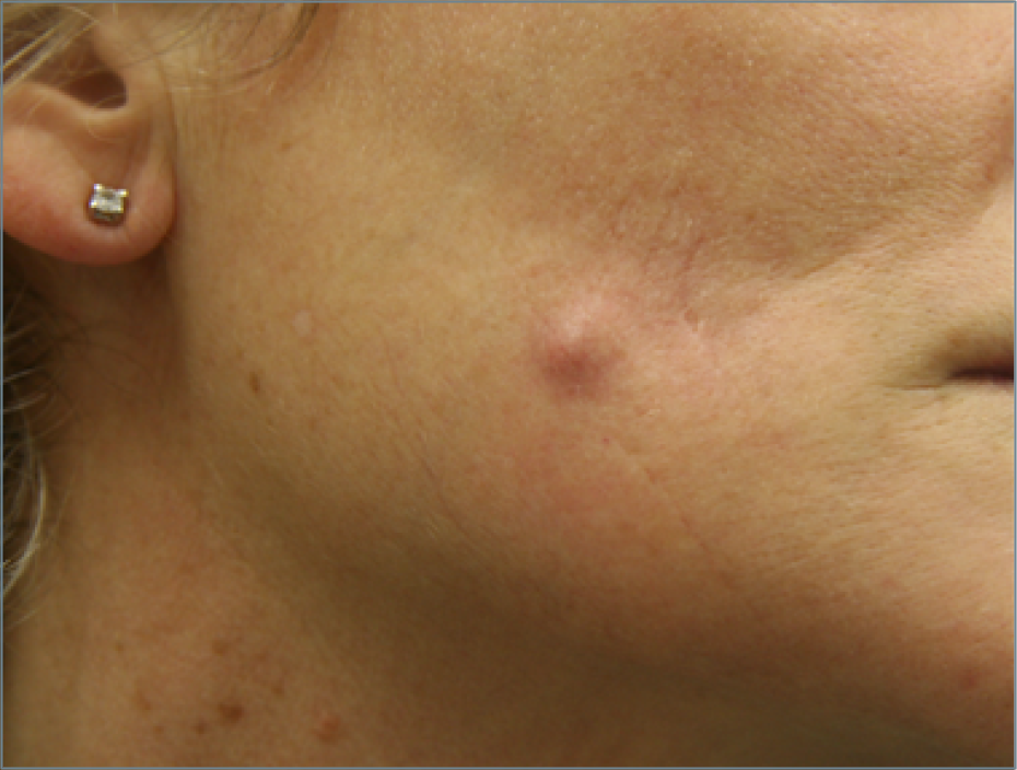  swelling or lumps at the injection site 