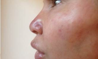 Swollen cheeks after filler injection