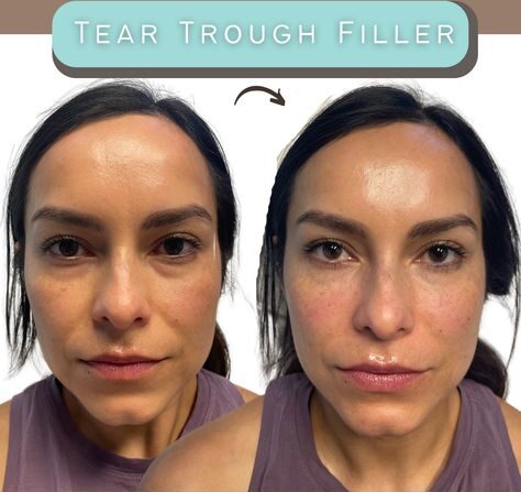 Tear Trough Filler Swelling: How to Manage It