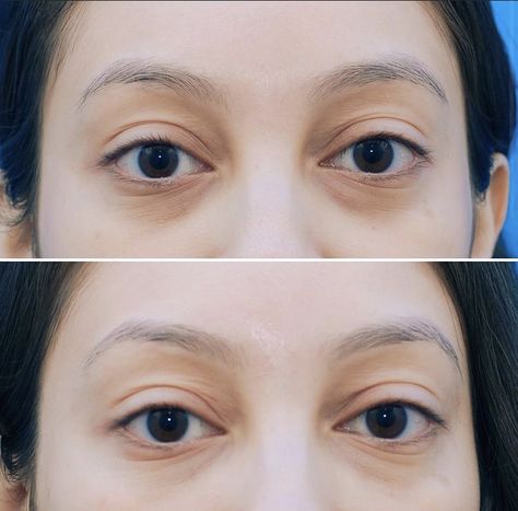 Tear Trough Filler Swelling: How to Manage It