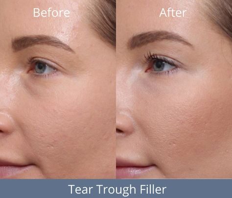 Tear Trough Filler Swelling: How to Manage It