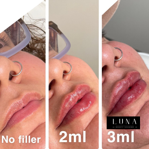 The difference between 2 - 3ml filler for 1 injection