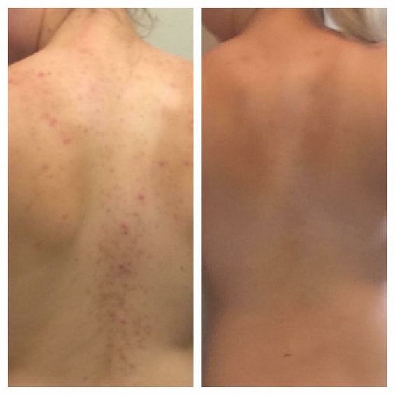 glycolic peel for back acne