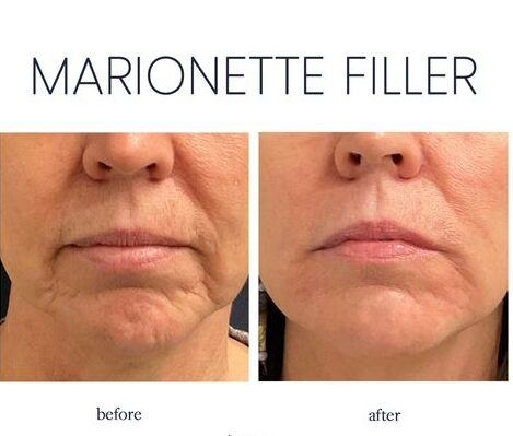 thread lift marionette lines before and after