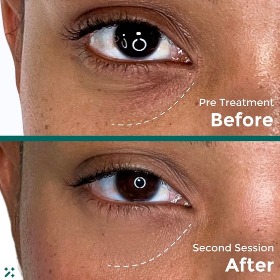 Under Eye and Cheek Filler: Before and After