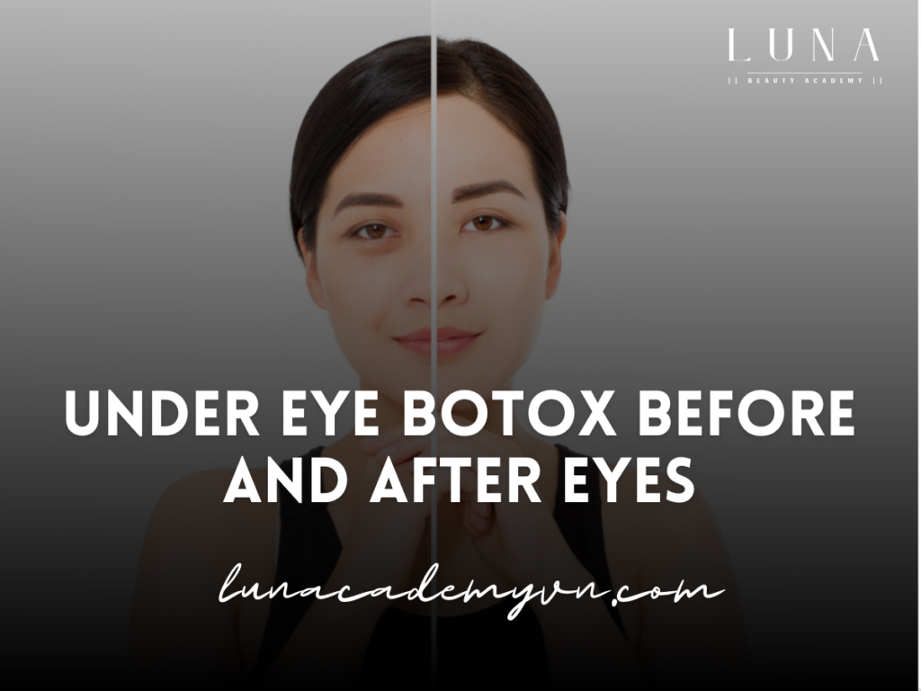 Under eye Botox before and after eyes