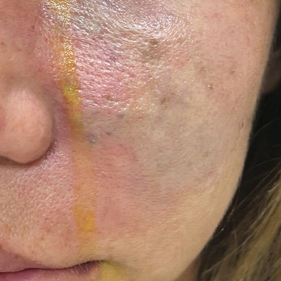 Vascular Complications after filler injection