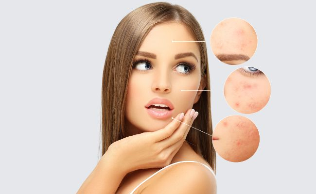 Vitamin B deficiency leads to peeling skin