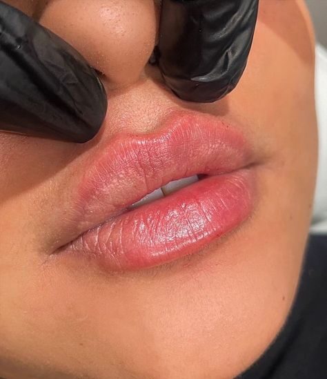 What Is Russian Lip Filler?