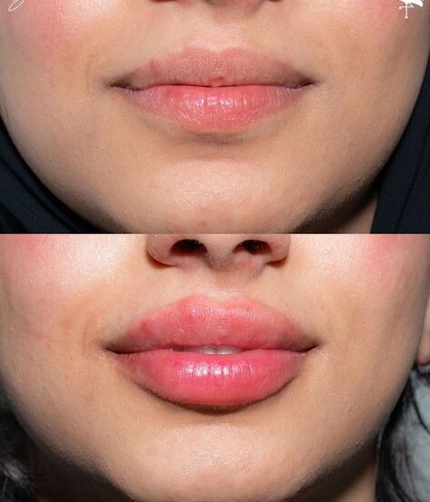 What Is Russian Lip Filler?