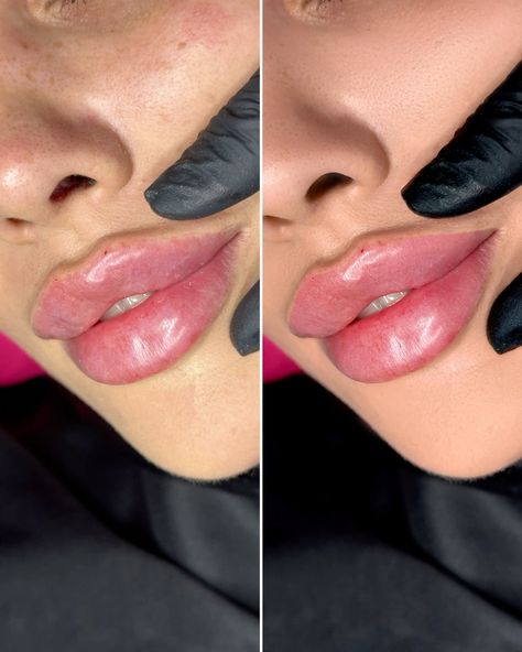 What Is Russian Lip Filler?