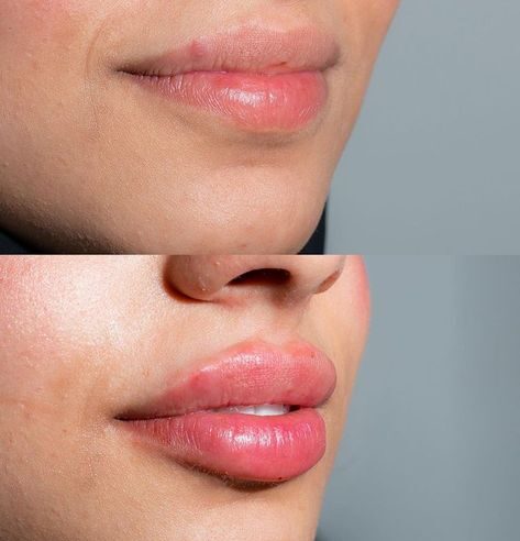 What Is Russian Lip Filler?