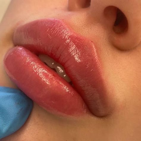 What Is Russian Lip Filler?