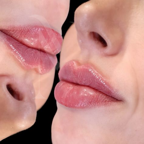 What Is Russian Lip Filler?