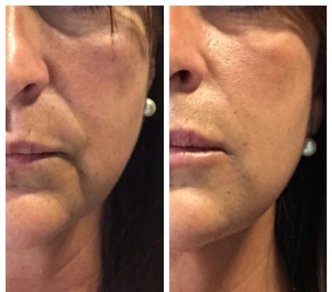 What is the Best Dermal Filler for Nasolabial Folds?