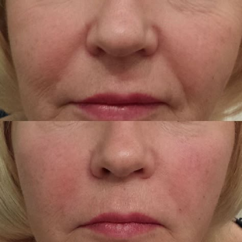 What is the Best Dermal Filler for Nasolabial Folds?