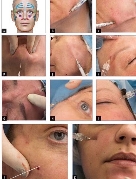 What is the Best Dermal Filler for Nasolabial Folds?