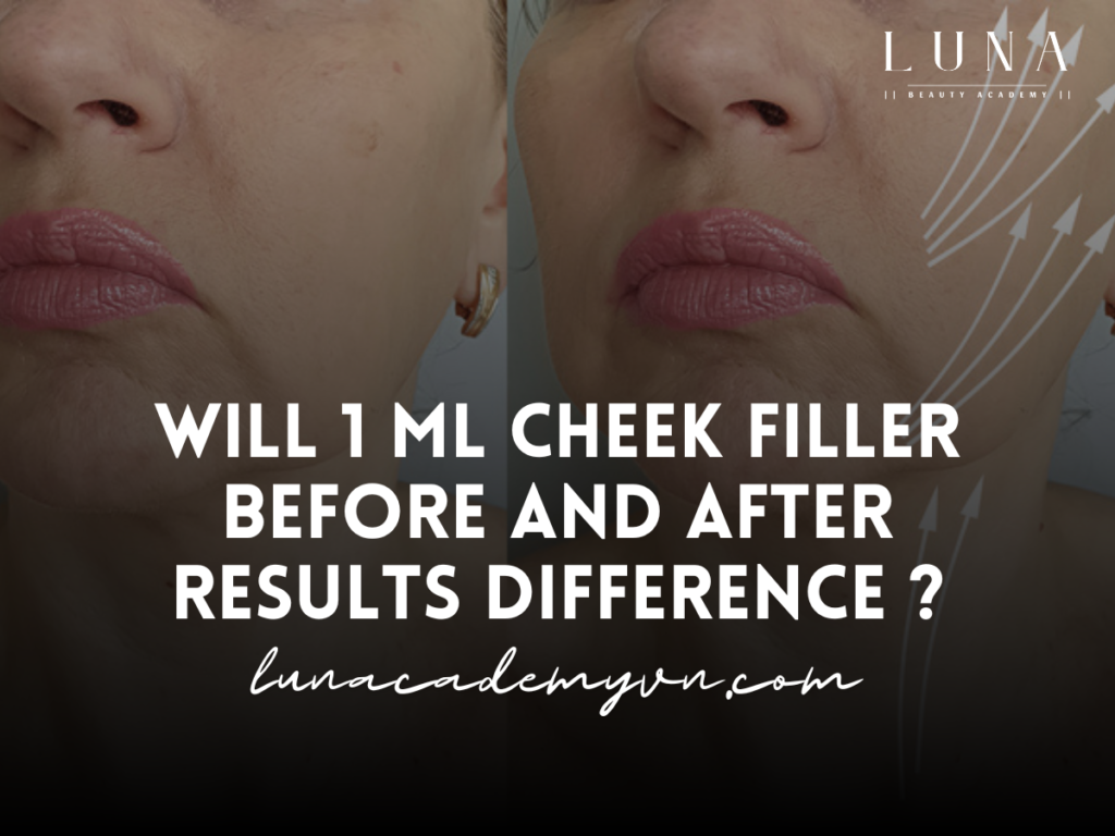 1 ml cheek filler before and after