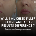 Will 1 ml cheek filler before and after results difference ?