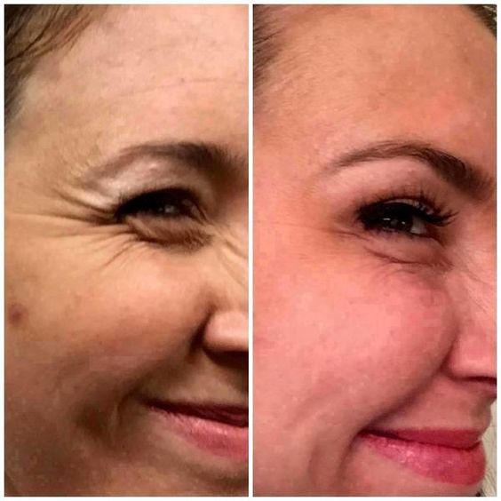 Wrinkle Reduction