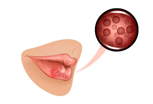 yeast infection lips symptoms