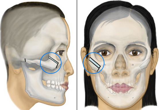 Your facial structure will partly determine the result.