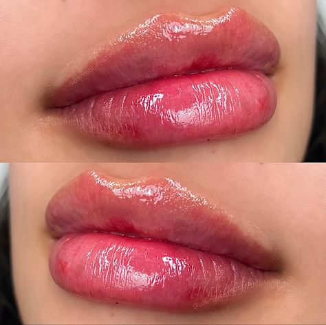  1 ml Lip Filler Manila: Enhance Your Natural Beauty