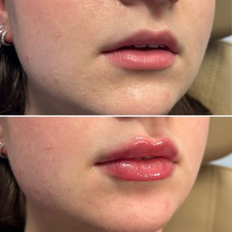 1 ml Lip Filler Manila: Enhance Your Natural Beauty